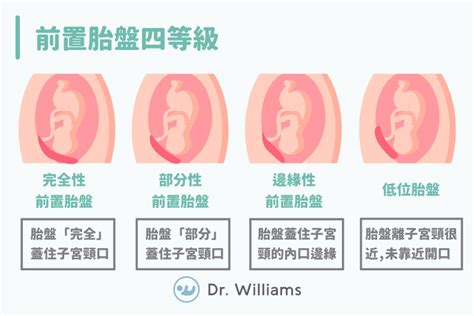 前置胎盤 症狀|前置胎盤有4種，一張圖帶你秒懂｜Mombaby 媽媽寶 